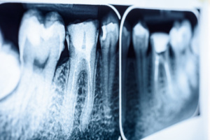 Root canal | dental jokes | Loudoun County pediatric dentist